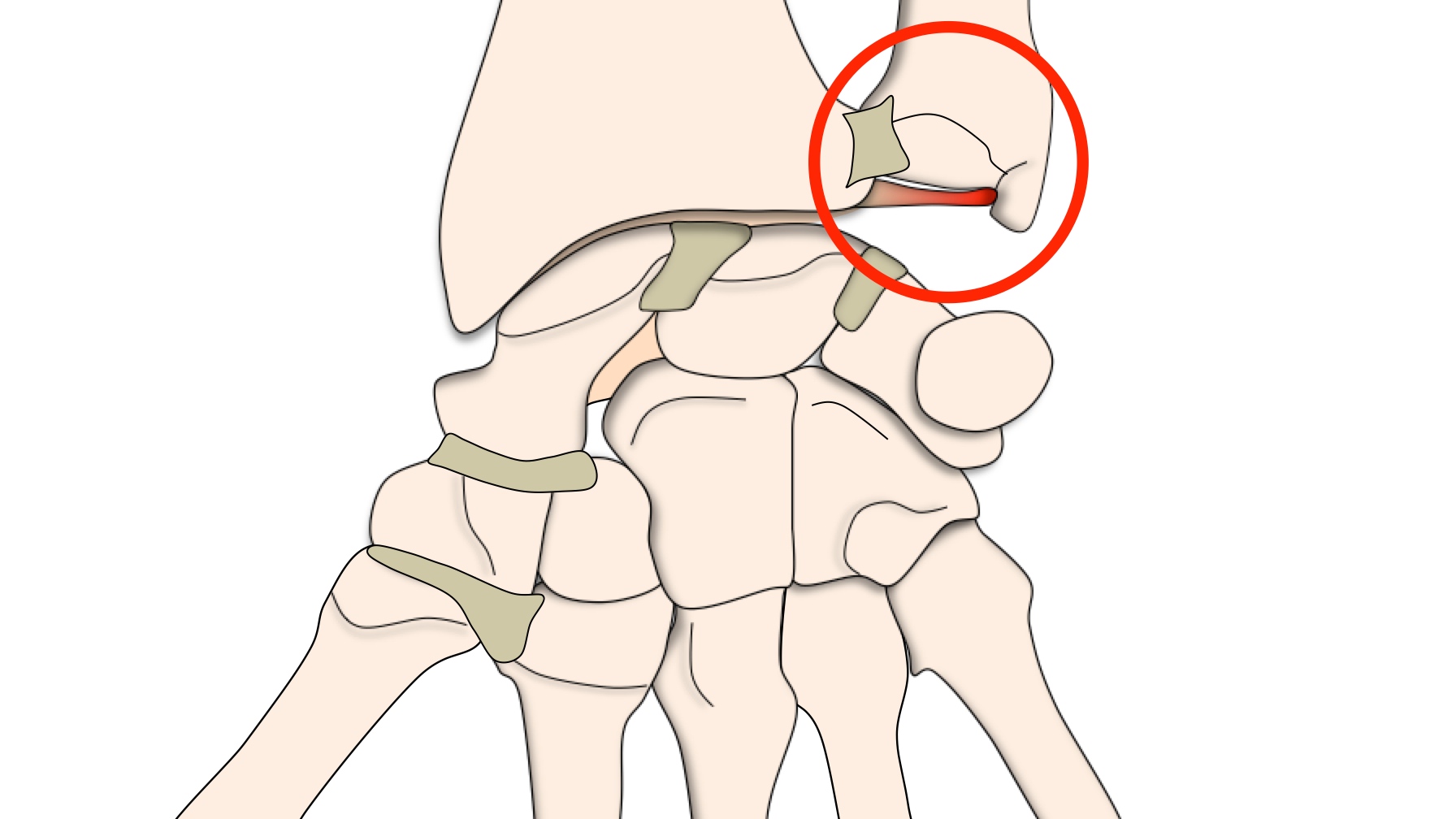 Entorses du poignet Lésions ligamentaires Clinique Ostéo